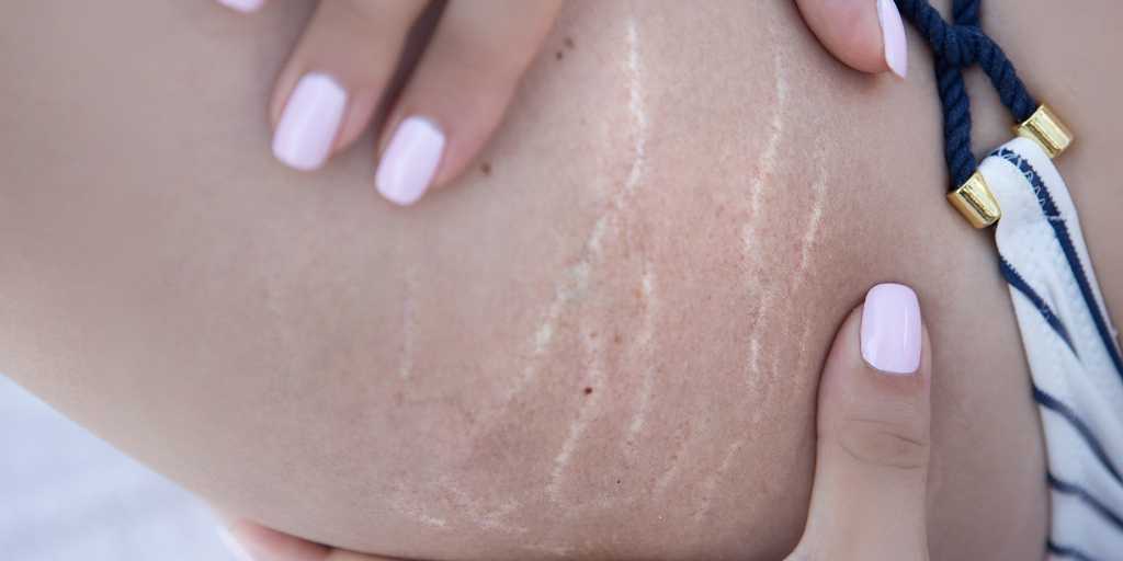 Stretch Marks: How can you prevent them?