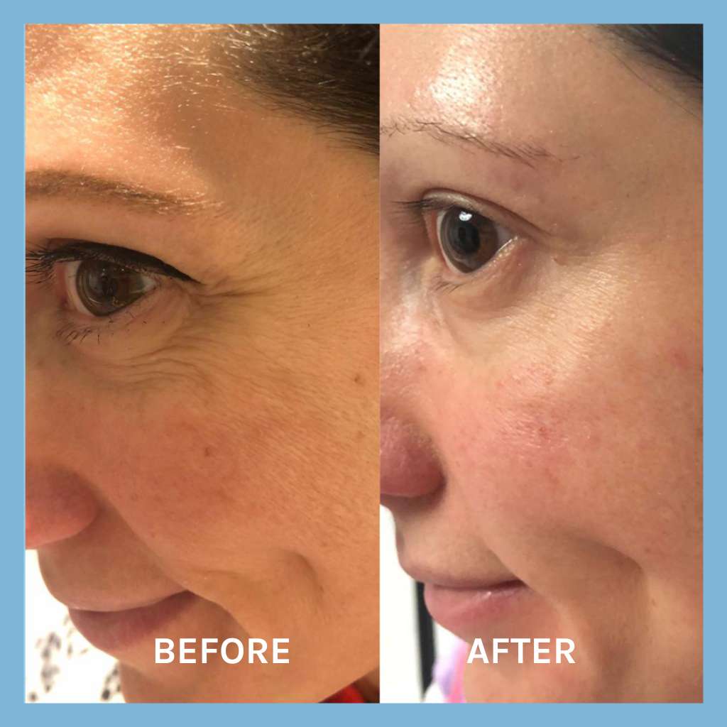 lifting serum before and after results