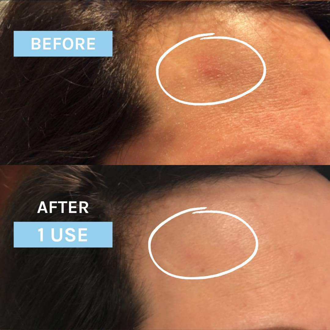before and after skincare photo using organic ceramide serum on sensitive skin